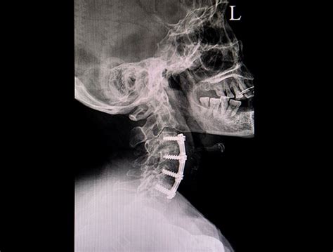 Anterior Cervical Discectomy Microscopic Asian Spine Hospital