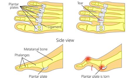 Plantar Plate Tear Exercises Created By A Foot Specialist