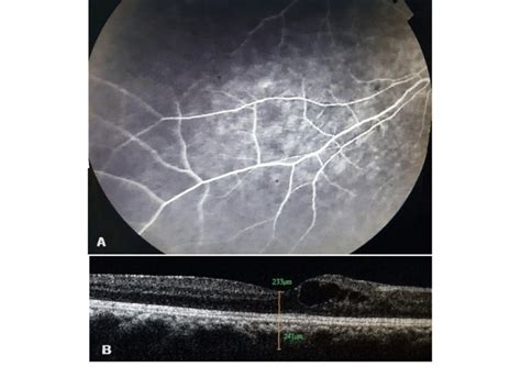 Fundus Fluorescein Angiography FFA Image Showing Peripheral Vascular