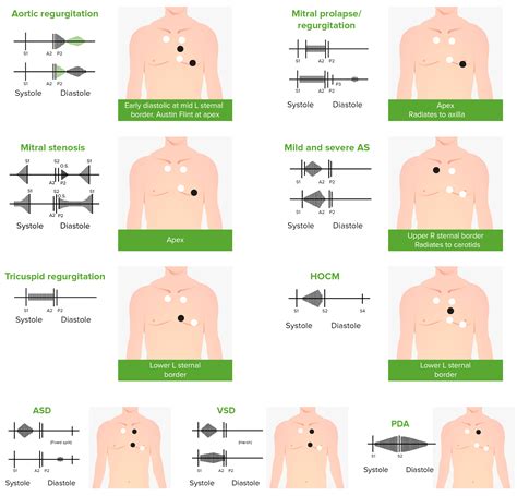 Mitral Regurgitation Concise Medical Knowledge