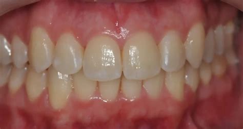 Invisalign Treatment Before And After Photos Westcoast Smile