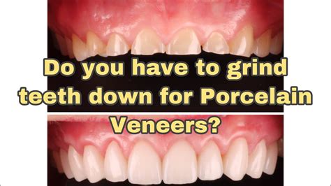 Do You Have To Grind Shave Teeth For Porcelain Veneers Youtube