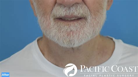 Before and After Neck Lift | Pacific Facial Plastic Surgery