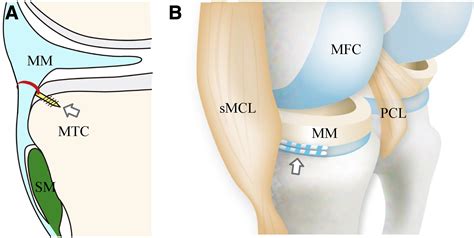 Arthroscopic Belt Capsulodesis Using A Knotless Soft Suture Anchor For