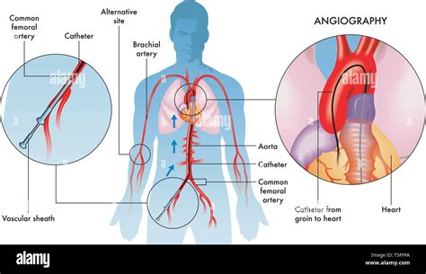 Angiogram