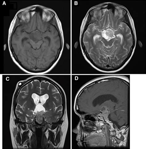 First Pituitary Magnetic Resonance Imaging With A Giant Prolactinoma