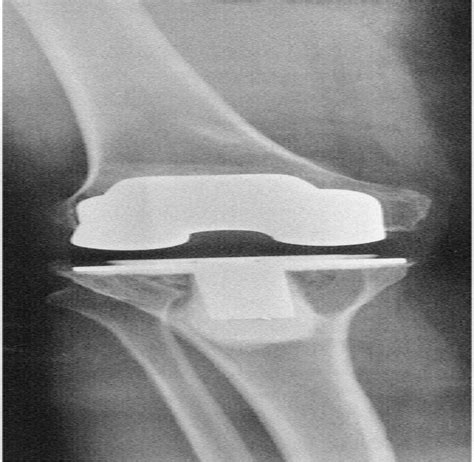 Tibial Post Impingement In Posterior Stabilized Total Knee A