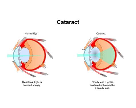 Cataract Symptoms And Causes All You Need To Know About