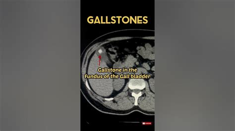 Gallstones Diagnosis Gallbladder Ct Abdomen Radiology Gallstones