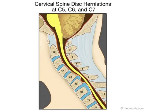 Cervical Spine Disc Herniations At C C And C Medmovie