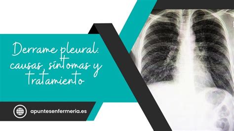 Derrame pleural causas síntomas y tratamiento Apuntes enfermería