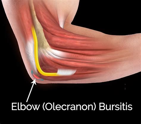 Olecranon Bursitis