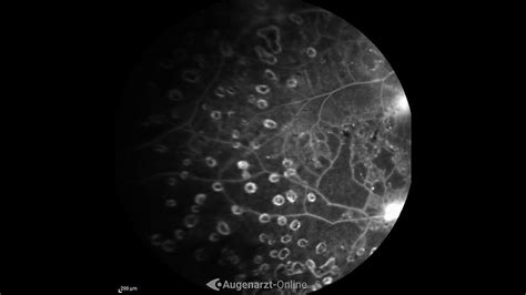 ALK Laser Herde Atlas Der Augenheilkunde