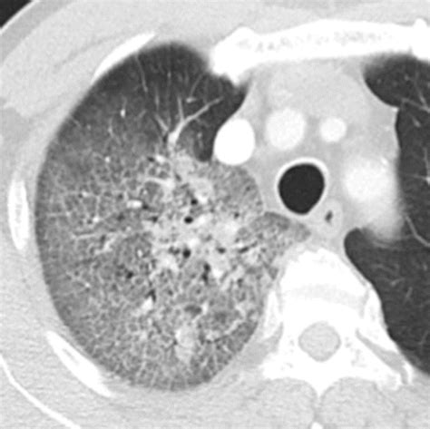 Atypical Pneumonia Definition Causes And Imaging Features