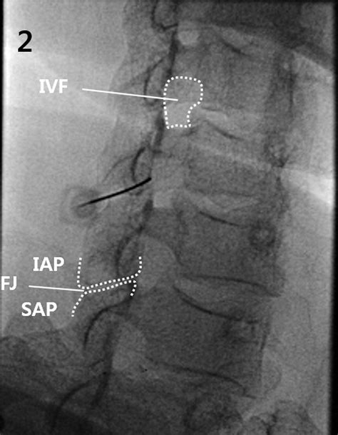 Fluoroscopically Guided Epidural Injections Of The Cervical And Lumbar