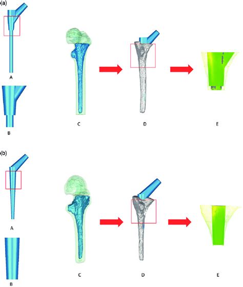 Examples Of Reconstructed Femoral Implants In The Modular And Conical