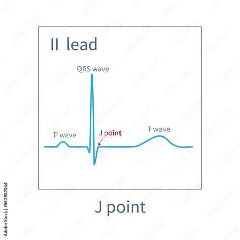 Qrs Complex Depolarization