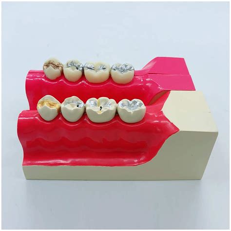 Buy Tooth Template Pcs Dental Molar Cross Section Template Of The