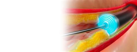 A Guide To Laser Angioplasty Types Procedure Benefits And Risks