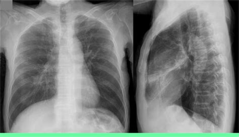 Atelectasis Chest X Ray