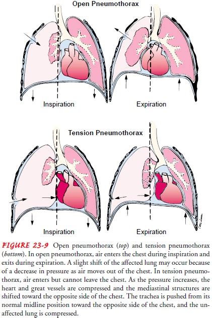 Open Pneumothorax Vs Tension Pneumothorax