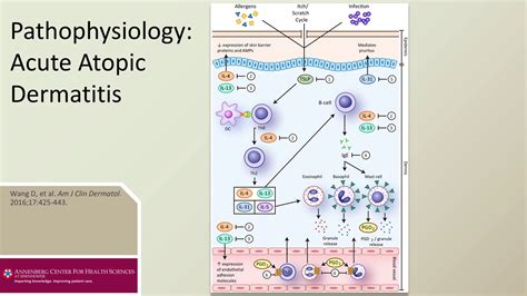 Treatment Of Moderate Severe Atopic Dermatitis Line 1 Stop 1 Overview