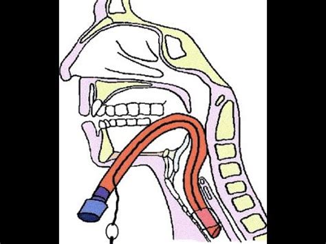 Submental Intubation For Maxillofacial Procedures Youtube