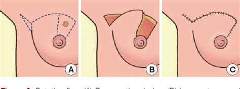 Figure From Surgical Techniques For Personalized Oncoplastic Surgery