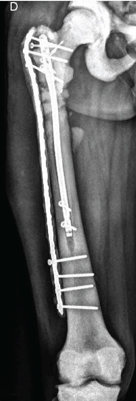 Postoperative Anteroposterior A And Lateral B Radiographs Of The