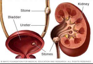 Kidney Stones: Causes, Symptoms, And Available Treatments