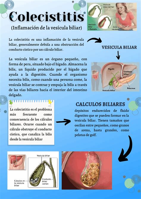 Experto Enaguas Comentarista Calculo De La Vesicula Biliar Con