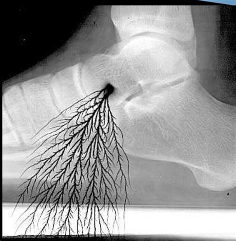 Radiography Ii Artifacts Flashcards Quizlet