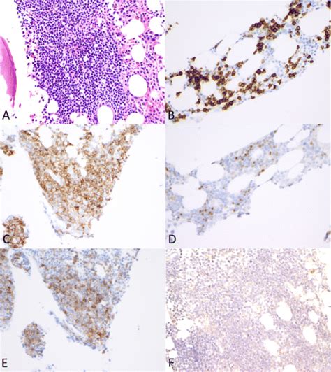 A Hande Section Shows Bone Marrow With A Lymphoid Aggregate Composed Of