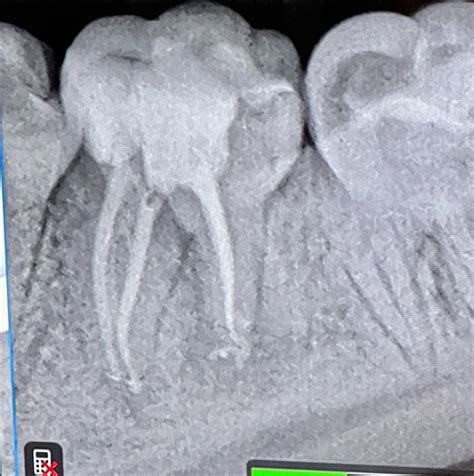 Fred Barnett On Linkedin Everyday Molar Endo By First Year Einstein