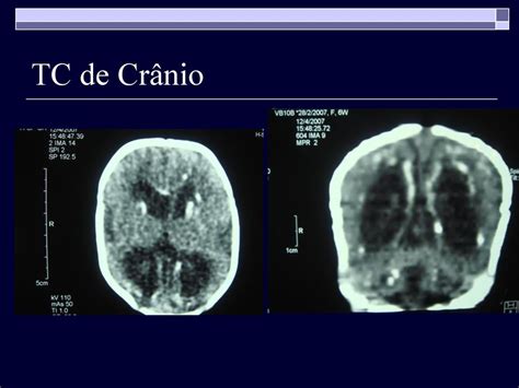 Caso Cl Nico Parvovirose Internato Em Pediatria Escs Hras Ppt