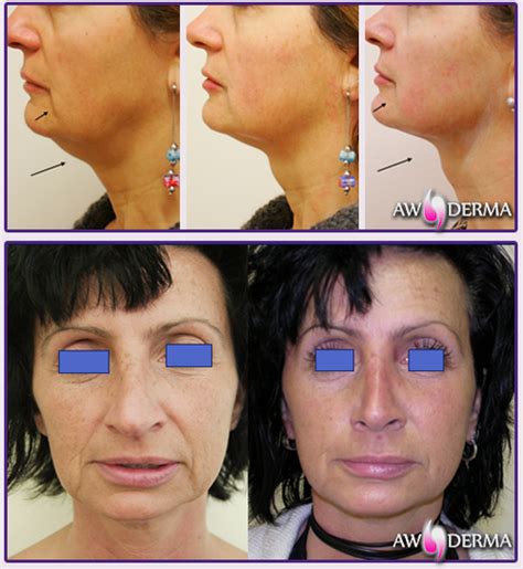 Ultraformer Iii Aw Derma Wroc Aw Dermatologia I Medycyna Estetyczna