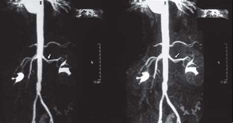 Figure 1 From Flash Pulmonary Edema Heralding Renal Artery Spasm Semantic Scholar