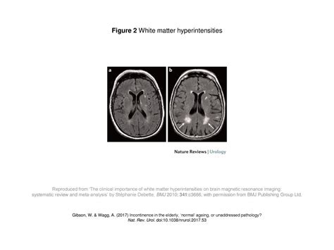 Figure 2 White Matter Hyperintensities Ppt Download