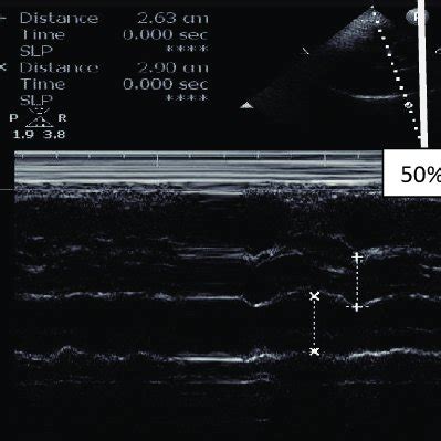 6 ETT Machine Picture In the 7 is patient ETT procedure is given ...