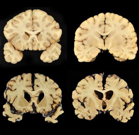 Chronic Traumatic Encephalopathy Market Opportunities