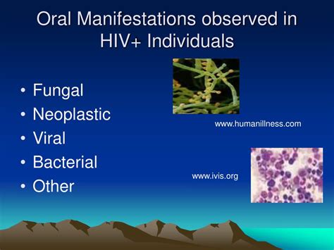 Ppt Oral Health And Hiv Powerpoint Presentation Free Download Id