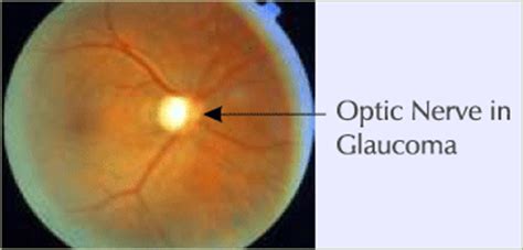 Drushti Eye and Retina Centre|Disease and Treatments| Glaucoma