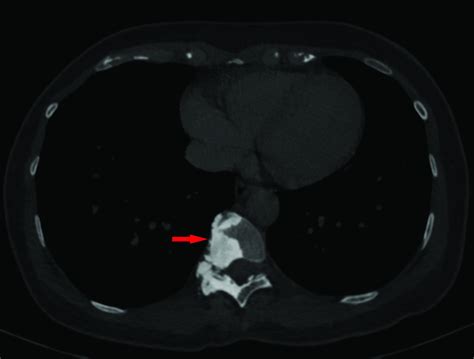 A Case Of Spinal Melorheostosis Journal Of Clinical Imaging Science