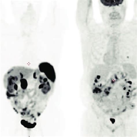 68 Ga DOTATOC PET CT Scan As Additional Finding In The Medial Lip Of