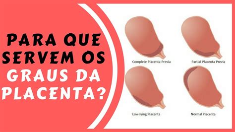 Placenta Grau 2 O Que Significa - Para que Servem os GRAUS DA PLACENTA? | #009 - YouTube