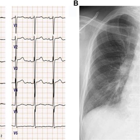 A A 12 Lead Electrocardiogram Demonstrated Normal Sinus Rhythm With