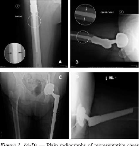 Figure 1 From The Survivorship Of Revision Total Hip Replacement With Severe Proximal Bone