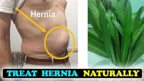 How To Get Rid Of Hernia Without Surgery YouTube