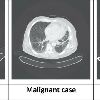 Sample of three types of CT SCAN of patients in classification operation. | Download Scientific ...