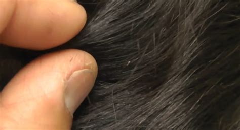 Do You Suffer From Dandruff Or Lice How To Tell The Difference And Get